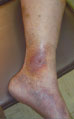 Chronic inflammation and venous ulceration.